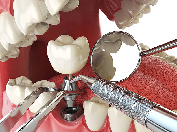 Best Emergency Root Canal Treatment in St Paul, MN